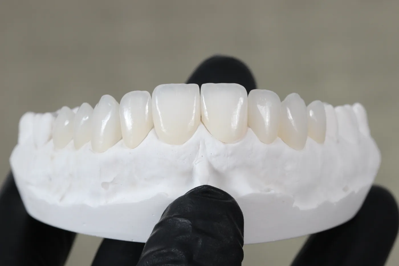 Carillas dentales de porcelana