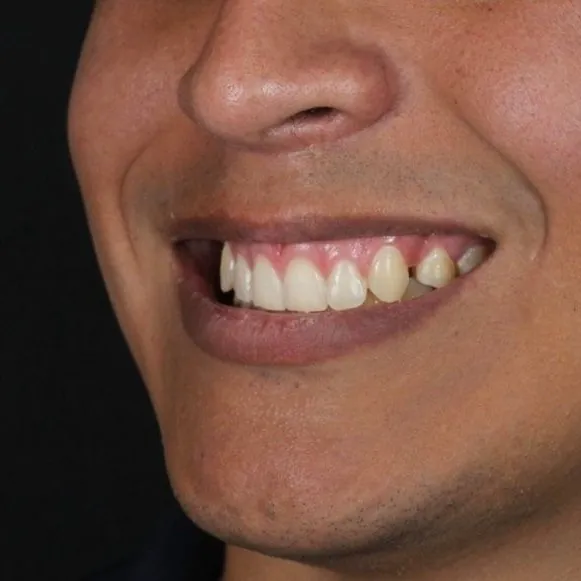 Maquillaje dental · Diego, antes del tratamiento