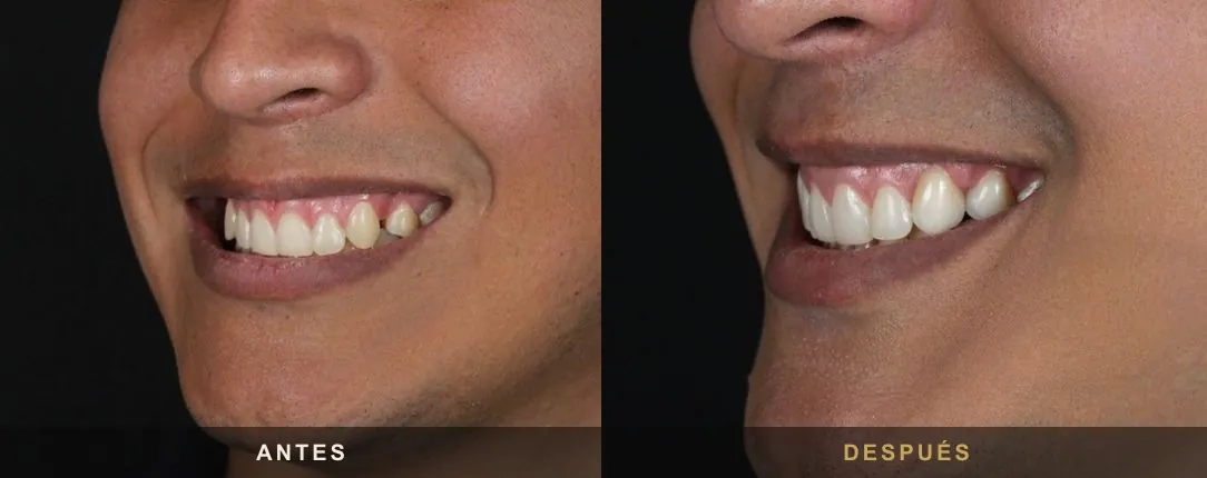 Cierre de espacios (diastema)