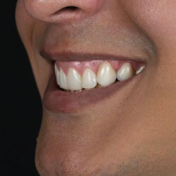 Maquillaje dental · Diego, después del tratamiento