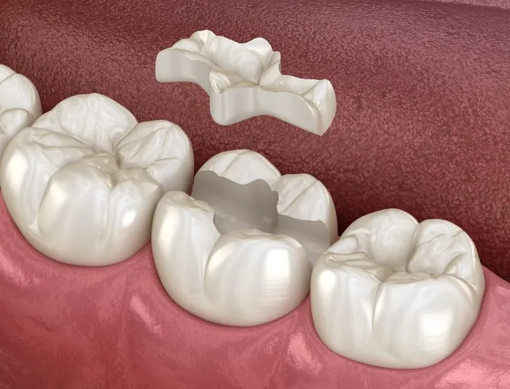 Tratamiento de caries