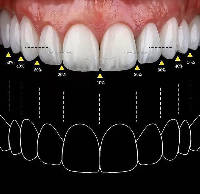 Diseño de sonrisa
