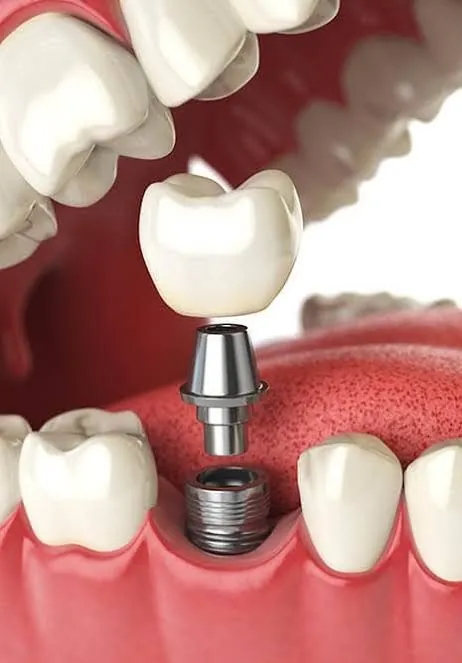 Implantes dentales