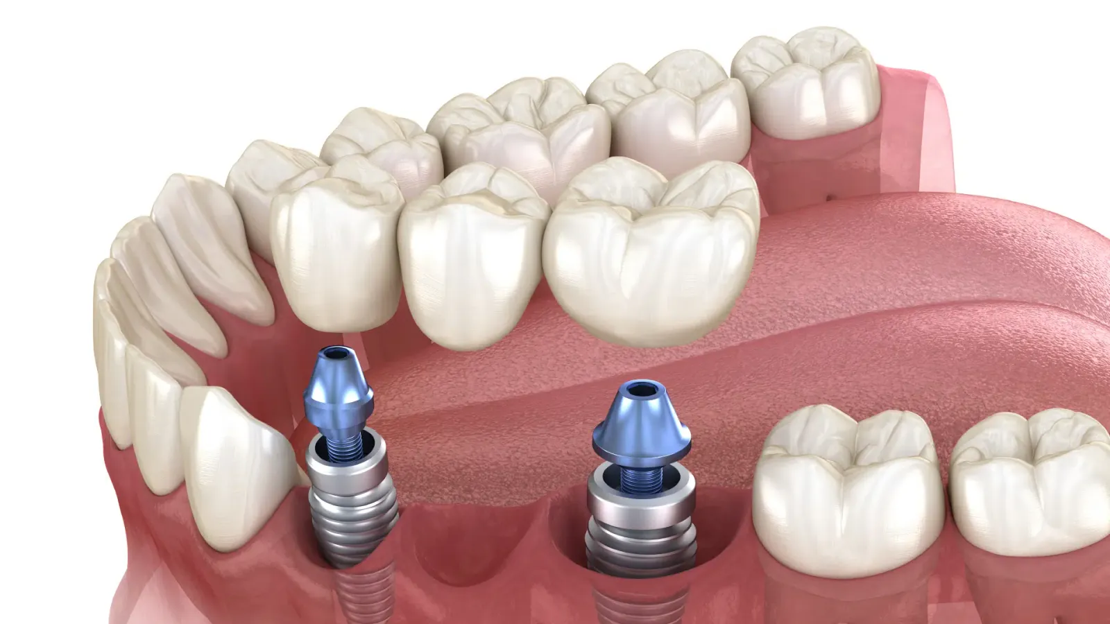 Puente sobre implantes